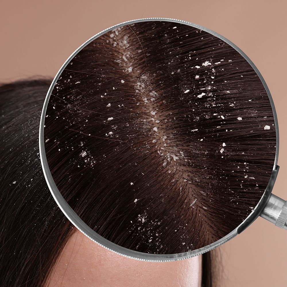 Shampoo bij Schilfertjes 200 ml
